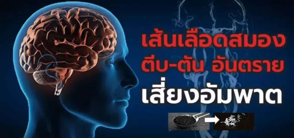 anyconv.com โรคหลอดเลือดสมอง